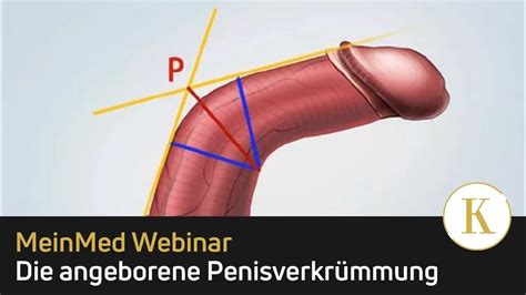 peniskrankheiten|Entzündung des Penis